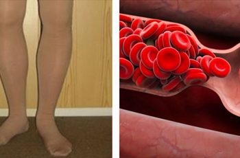 7 Warning Signs Of A Possible Blood Clot That No One Should Ignore