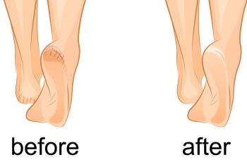 3 Simple Tricks To Heal Your Cracked Heels At Home