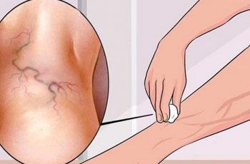 Get Rid of Varicose Veins With This Everyday Ingredient