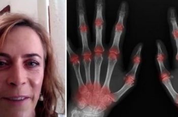 Woman Gets Rid Of Her Rheumatoid Arthritis From One Simple Lifestyle Change