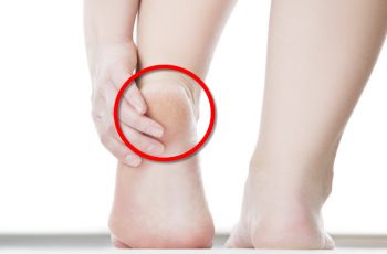Grandma Told Me This Trick. It Healed My Cracked Heels In Just A Few Days