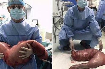 Doctors Remove 28 Pounds Of Feces From Constipated Man