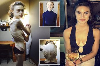 Anorexic Says Instagram Recovery Accounts Saved Her