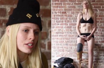 Model Who Lost Leg After Tampon Mishap May Lose Other Leg
