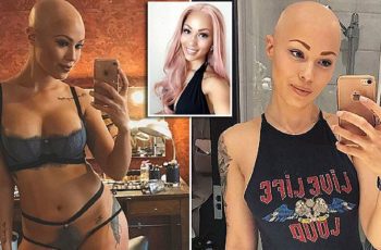 Woman With Alopecia Is Now A Model After Struggling To Accept It